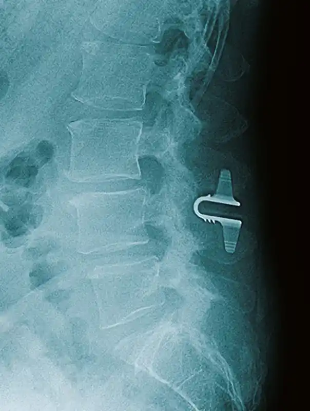 Coflex X-Ray