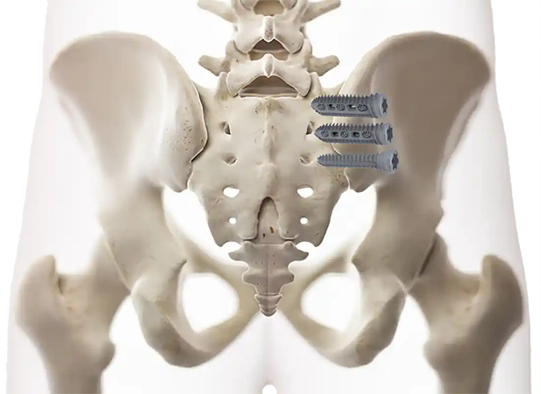 Lateral SI Fusion